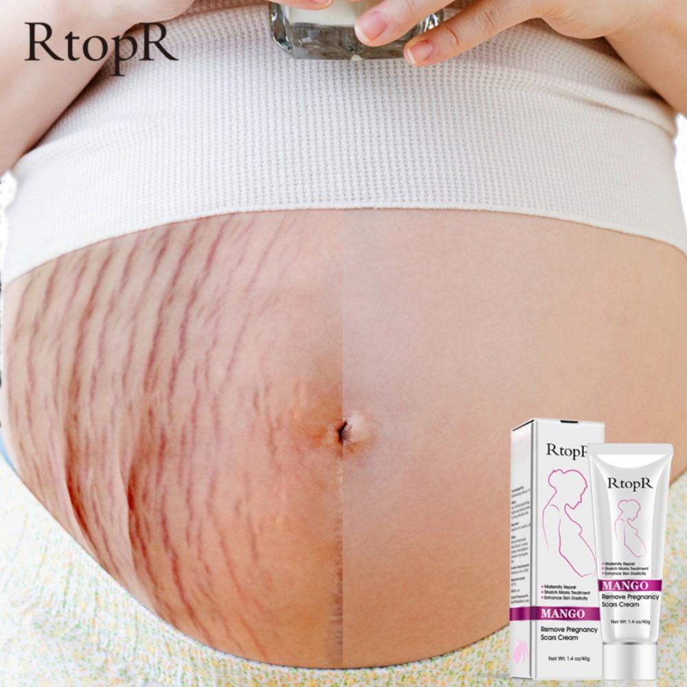 Remove Pregnancy Scars Acne Cream Stretch Marks